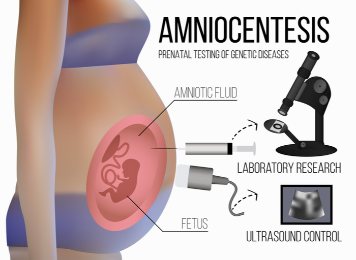 Amniocentesis