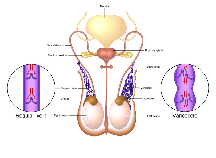 Varicocele